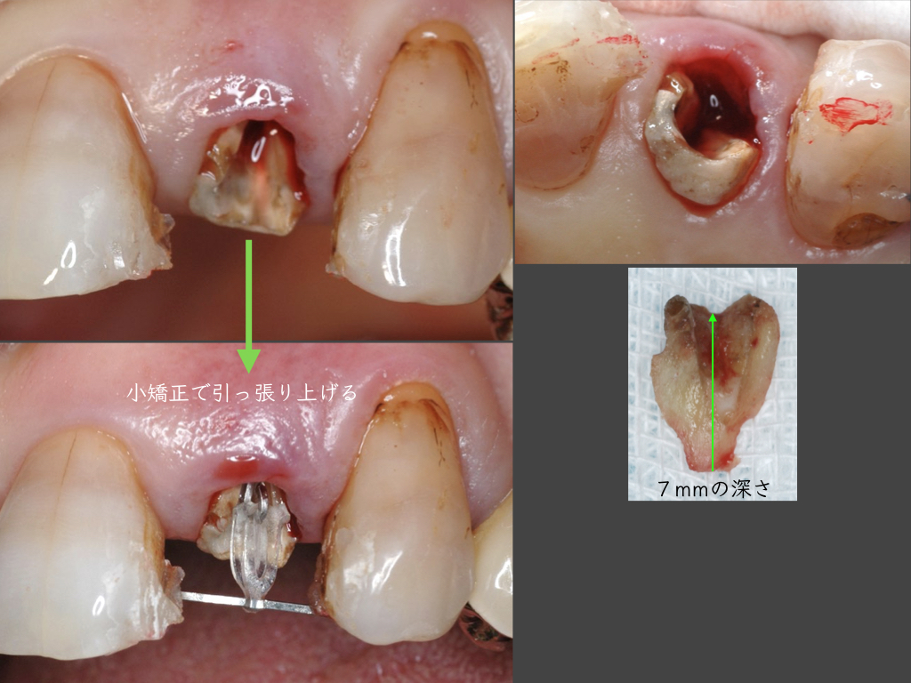 歯を残す治療(MTM)
