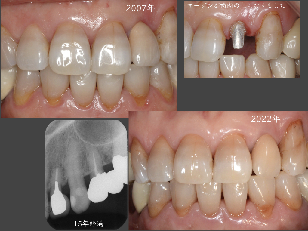 歯を残す治療(MTM)