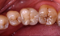 奥歯1本のインプラント治療