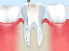 根管治療の重要性