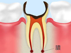 C4【歯根まで達した虫歯】
