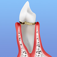 歯肉炎