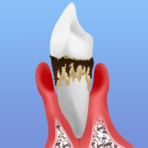 軽度歯周炎