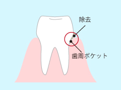 ルートプレーニング