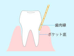 歯周ポケット掻把（そうは）術